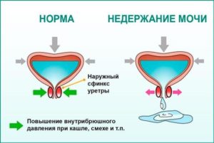 Мочеиспускание при смехе