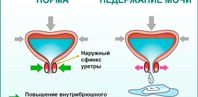 Мочеиспускание при смехе