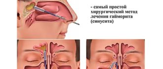 Можно ли играть в футбол в зале при гайморите?