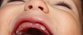 Нарушение порядка прорезывания зубов