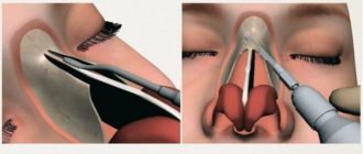 Давление после операции по исправлению перегородке носа повышенное. Что это?