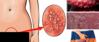 Чешутся половые губы у входа во влагалище