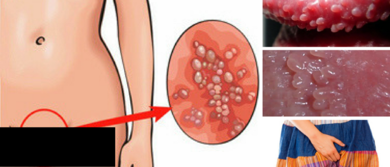 Чешутся половые губы у входа во влагалище