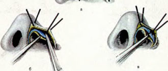 Деформация хряща крыла носа