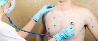 Ветрянка у взрослого