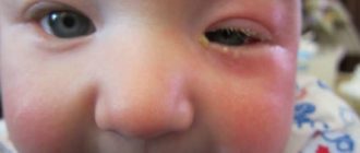 Дакриоцистит у 2 месячного ребёнка