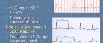 Можно делать общий наркоз при брадикардии, ритм синусовый