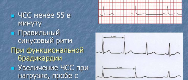 Можно делать общий наркоз при брадикардии, ритм синусовый
