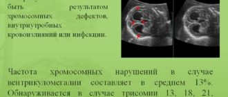 Вентрикуломегалия