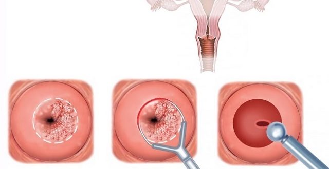 Можно ли делать биопсию шейки матки на 19 день цикла?