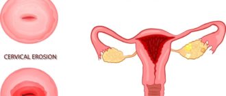 Эрозия шейки матки