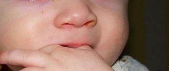 Воспаление глаз у ребенка 1г11м