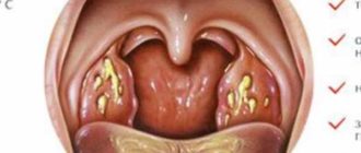 Воспаление горла на протяжении года