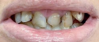 Ужасное состояние зубов, кариес на передних зубах, протезирование нужно