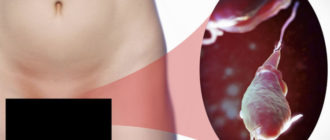 Можно ли, при наличии трихомонадной инфекции забеременеть?