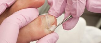 Воспаление после удаления вросшего ногтя