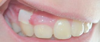 Надрез десны