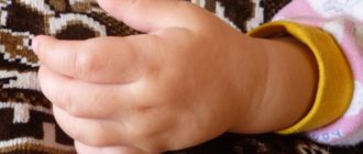 Мягка шишка на руке ребенка