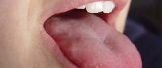 Воспаление и ямка на языке