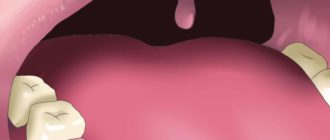 В лунке зуба серое содержимое