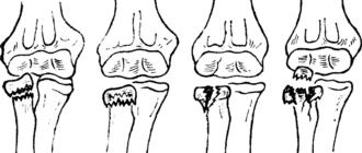 Внутрисуставный перелом головки лучевой кости