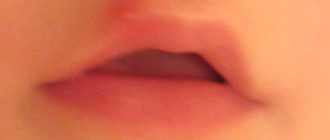 На губе у ребенка розовый прыщик