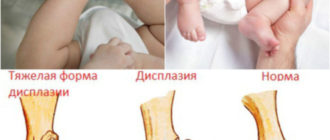 Дисплазия тазобедренных суставов