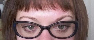 Возможно ли исправление косоглазия при 3°