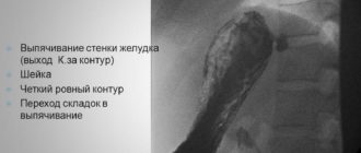 Выбухание стенки желудка