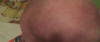 Мягкая шишка у ребенка 4 месяца