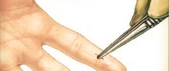 В пальце инородное тело