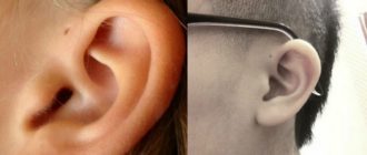 Воспалился околоушной свищ