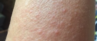 На бедрах появляются маленькие волдыри которые чешутся