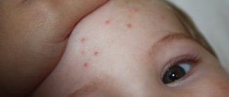 Ветрянка. Высыпания закончились а температура началась