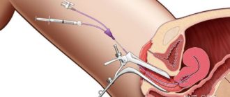 Вероятность беременности после чистки