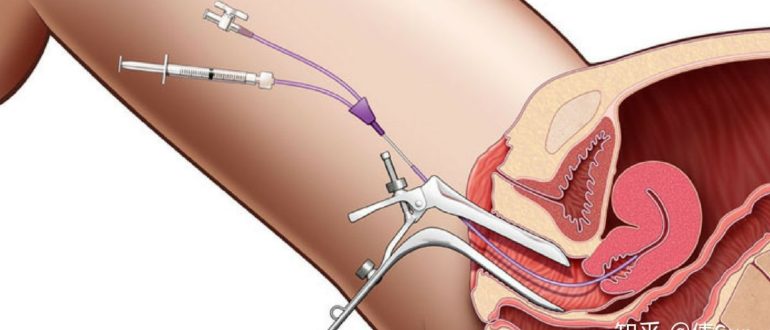 Вероятность беременности после чистки