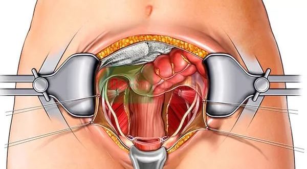 ЭКСТИРПАЦИЯ МАТКИ ЧЕРЕЗ ВЛАГАЛИЩЕ