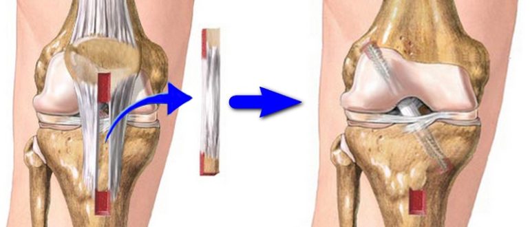 Восстановление после mpfl пластики надколенника