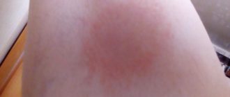 Чешется локоть опух покраснел и горячий что делать? ?