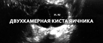 Двухкамерная киста