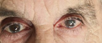 Возрастное слезотечение глаукома