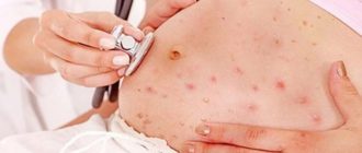 Ветряная оспа при беременности 13 недель