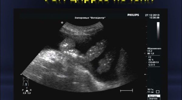УЗИ при гепатите С расшифровка