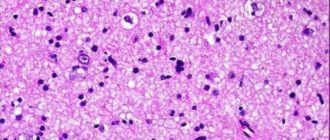 Диффузная астроцитома рецидив