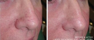 На носу появилась полоска фиолетового цвета