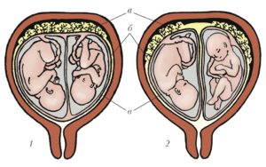 Двойня, плацента