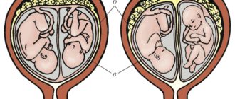 Двойня, плацента