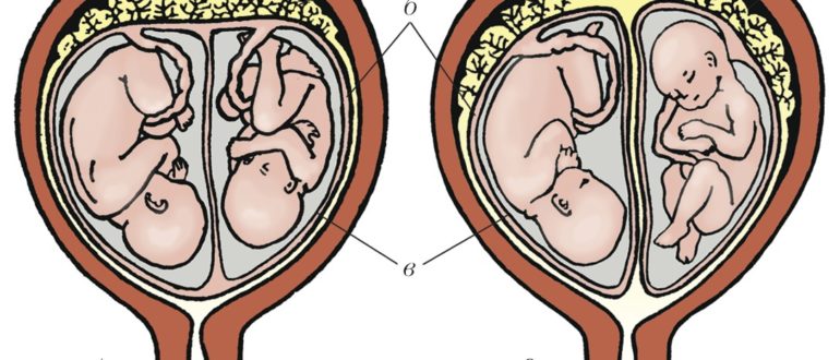 Двойня, плацента