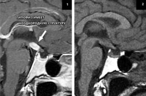 МР картина диффузно неоднородной структуры аденогипофиза