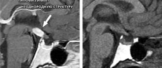 МР картина диффузно неоднородной структуры аденогипофиза